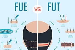 FUE and FUT: A Comparison to Choose the Best Method