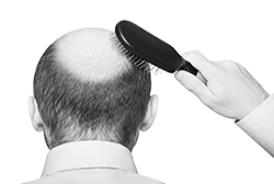Hair Loss Therapy: The Hairmax Powerflex Laser Cap