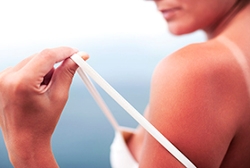 How To Treat Sunburns Quickly