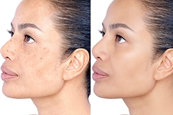 Newport Beach Dermatologist-Approved Dark Spots Treatments for Lasting Results