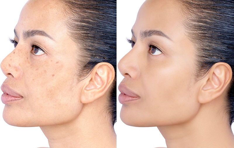 Newport Beach Dermatologist-Approved Dark Spots Treatments for Lasting Results