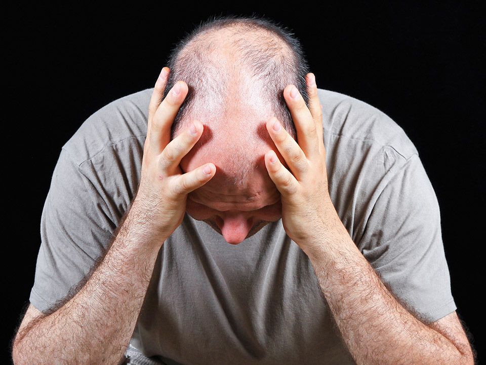 What is Male Pattern Baldness